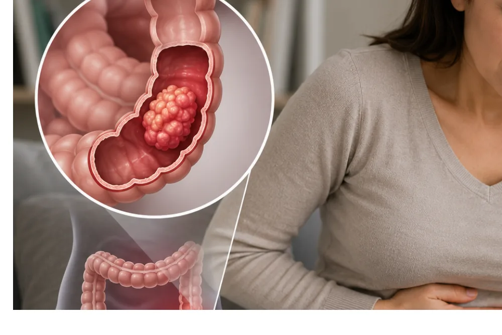 Cáncer colorrectal en Edo. Méx.