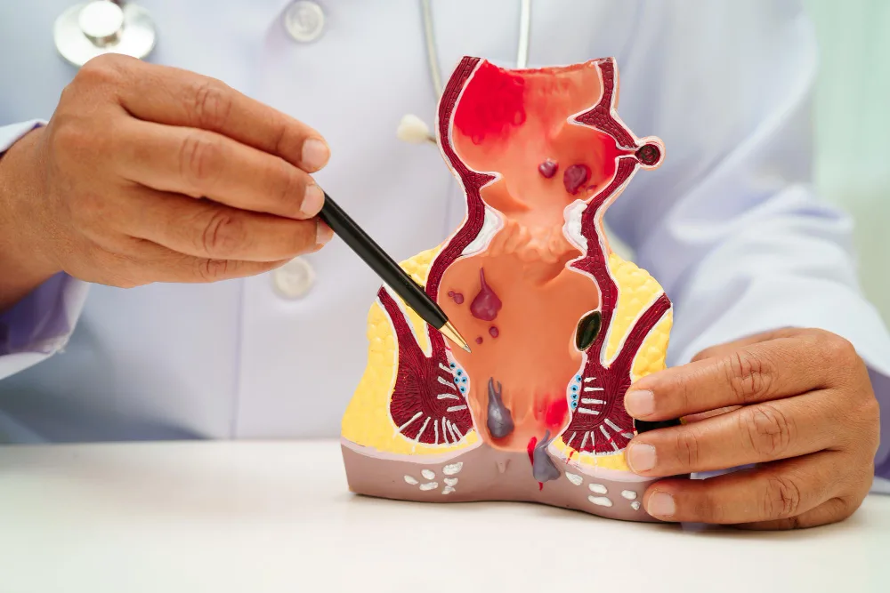 Colocación de toxina botulínica para dolor anal y fisura anal en Edo. Méx.