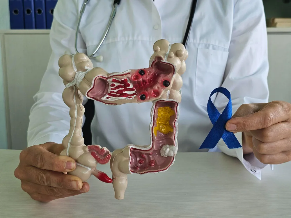 Diagnóstico temprano y prevención de cáncer de colon, recto y ano en Edo. Méx.